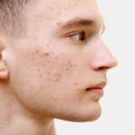Learn To Quickly Clear Up Troublesome Acne