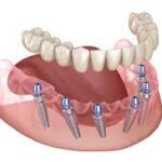 full mouth dental implants near me in Houston TX