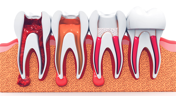 root canal near me