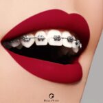 Dental braces in Dubai